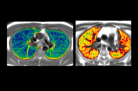 مقایسه اسکن MRI مغز در افراد سالم و مبتلایان به کووید-۱۹؛ نواحی زرد رنگ نشان‌دهنده کاهش چگالی ماده خاکستری است.